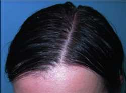 Mercado mundial de la alopecia