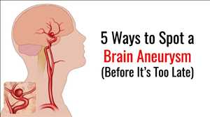 Aneurisma Cerebral