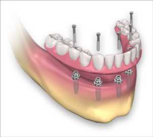 Prótesis dentales