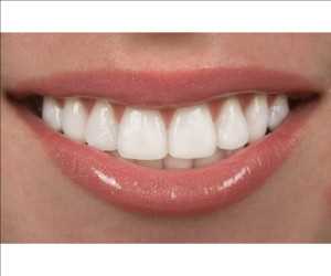 Carillas dentales