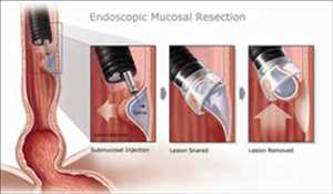 Resección endoscópica de la mucosa