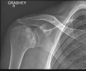 Articulación de la cabeza humeral