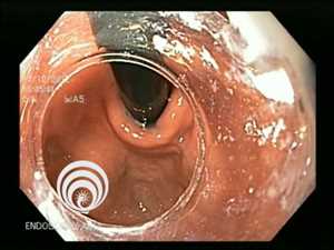 Endoscópico oral