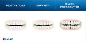 Periodontitis