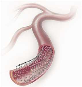 Stents vasculares periféricos