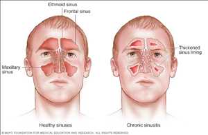 Sinusitis