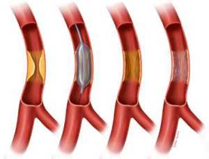 Global Dispositivos de cardiología intervencionista Datos históricos del mercado