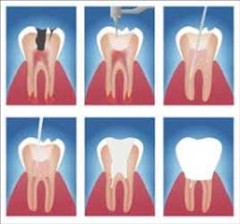 Tratamientos de endodoncia Mercado