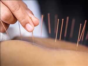 Acupuntura