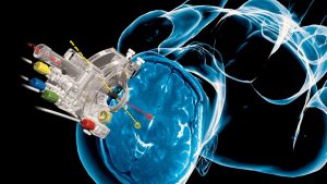 Mercado global de dispositivos de neurocirugía mínimamente invasivos