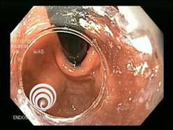 Endoscópico oral