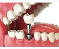 Sustituto de injerto óseo dental compuesto