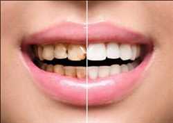 Carillas dentales