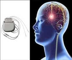 Dispositivos de estimulación cerebral profunda