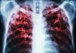 Mercado global de la terapéutica de la fibrosis quística
