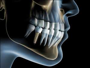 Implantes de Osteointegración