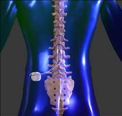 Estimuladores de la médula espinal