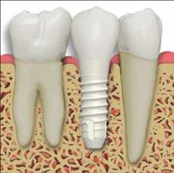 Implantes Dentales de Zirconio