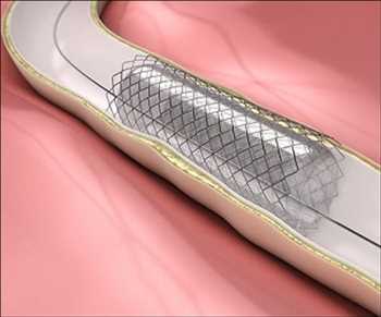 Global Stent carotídeo Tamaño de mercado