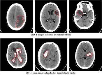 Global Accidente cerebrovascular hemorrágico y accidente cerebrovascular isquémico Cuota de mercado