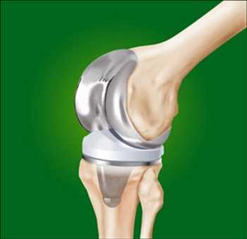 Global Implantes de reemplazo de rodilla Cuota de mercado