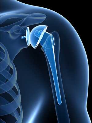 Global Implantes de hombro Tamaño de mercado