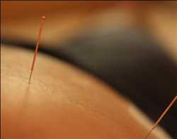 Agujas de acupuntura