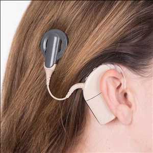 Cochlear Implants Tendencias de crecimiento del mercado