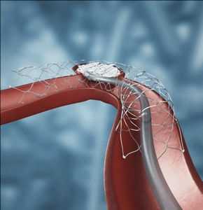 Intracranial Stents Mercado Demanda-Oferta