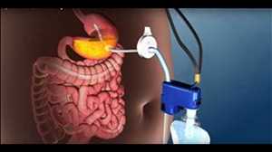 Weight Loss Stomach Pump Mercado Demanda-Oferta