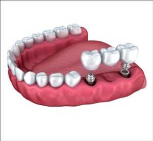 Perspectivas globales del mercado de implantes dentales