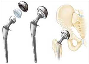 Análisis del mercado global de implantes de reemplazo de cadera