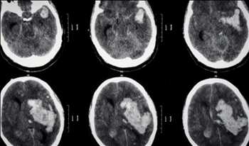 Global Anticoagulante oral Hechos del mercado