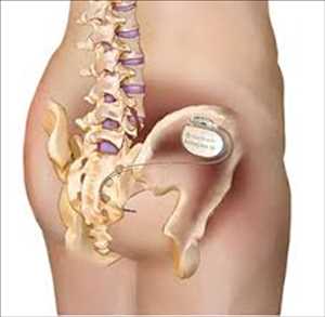 Global-Sacral-Nerve-Stimulation-Devices-Market
