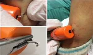 Tendencia global del mercado de autoinyectores de epinefrina