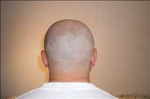 Medicamentos para la alopecia Mercado