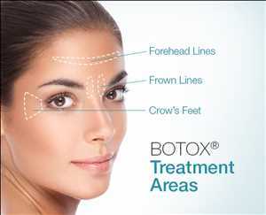 Botox Mercado