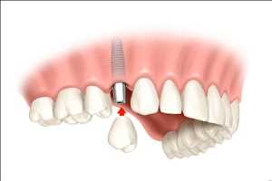 Implantes y prótesis dentales Mercado