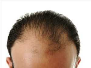 Tratamiento de la caída del cabello Mercado