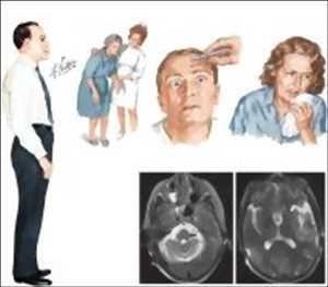 Parálisis supranuclear progresiva Mercado