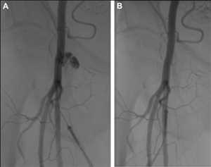 Global Dispositivos de cierre vascular y apósitos hemostáticos Cuota de mercado
