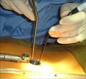 Global-Minimally-Invasive-Spine-Surgery-Market