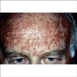 Global 5-fluorouracilo Mercado