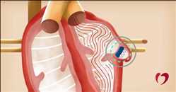 Dispositivo de fibrilación auricular
