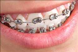 Global Brackets dentales Mercado