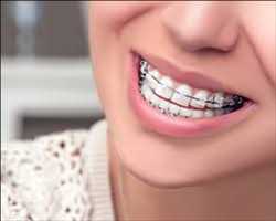 Global Orthodontic Supplies Market Demand