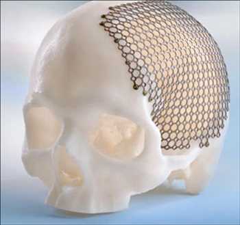 Global Implantes craneomaxilofaciales Pronóstico del mercado