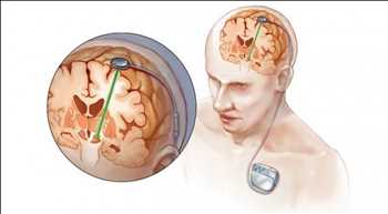 Global Sistemas de estimulación cerebral profunda Oportunidades de mercado