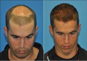 Global Restauración del cabello Alcance futuro del mercado