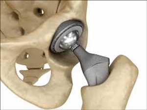 Dispositivos de reparación conjunta Mercado Demanda-Oferta